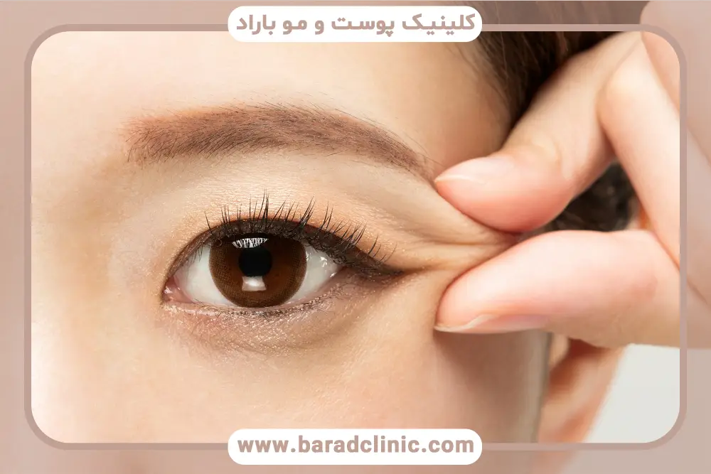 مراقبت‌های بعد از بلفاروپلاستی چشم آسیایی 