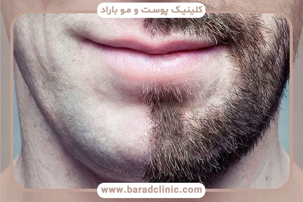 هزینه کاشت ریش روی چانه 