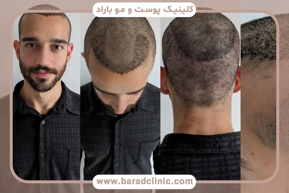 موارد قابل بررسی در مقایسه عکس کاشت مو بعد از سه ماه 