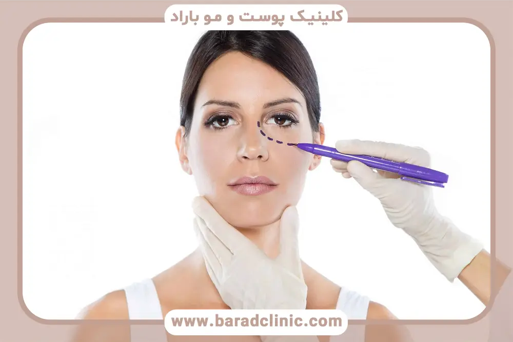 درمان‌های خانگی چسبندگی پلک بعد از بلفاروپلاستی