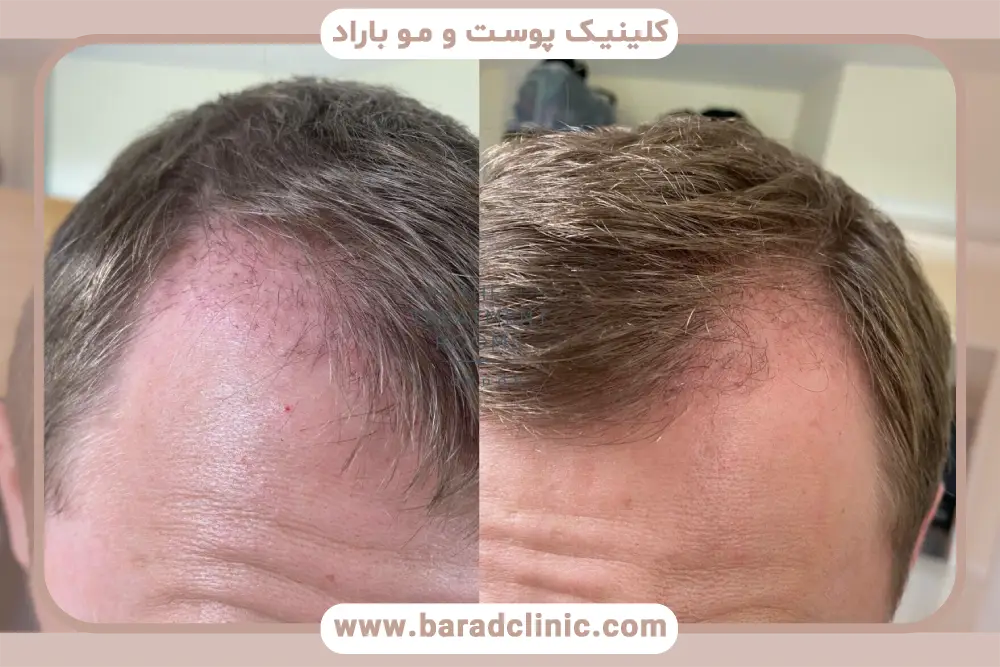 نتایج بهتر نسبت به عکس کاشت مو بعد از دو ماه
