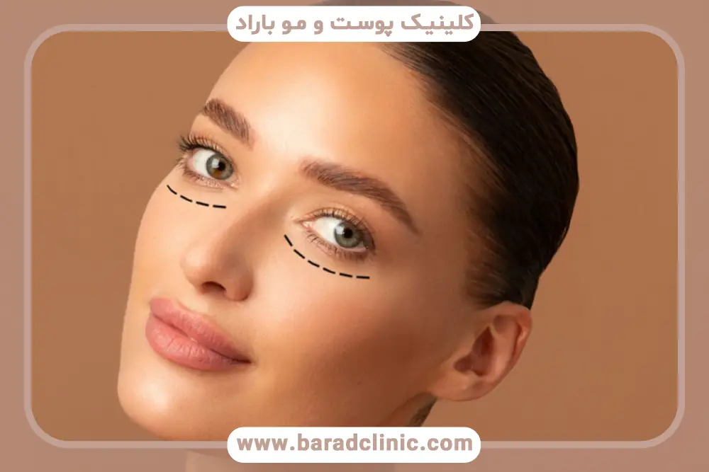 عوارض شروع سریع ورزش بعد از بلفاروپلاستی 