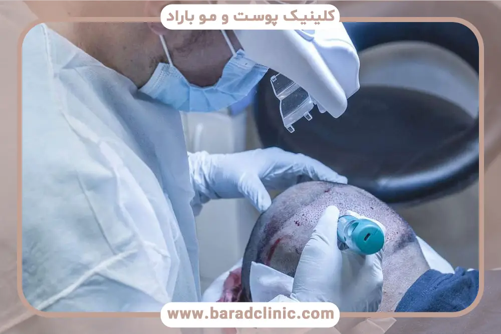 تاثیر دستگاه کاشت مو  روی نتایج طبیعی 