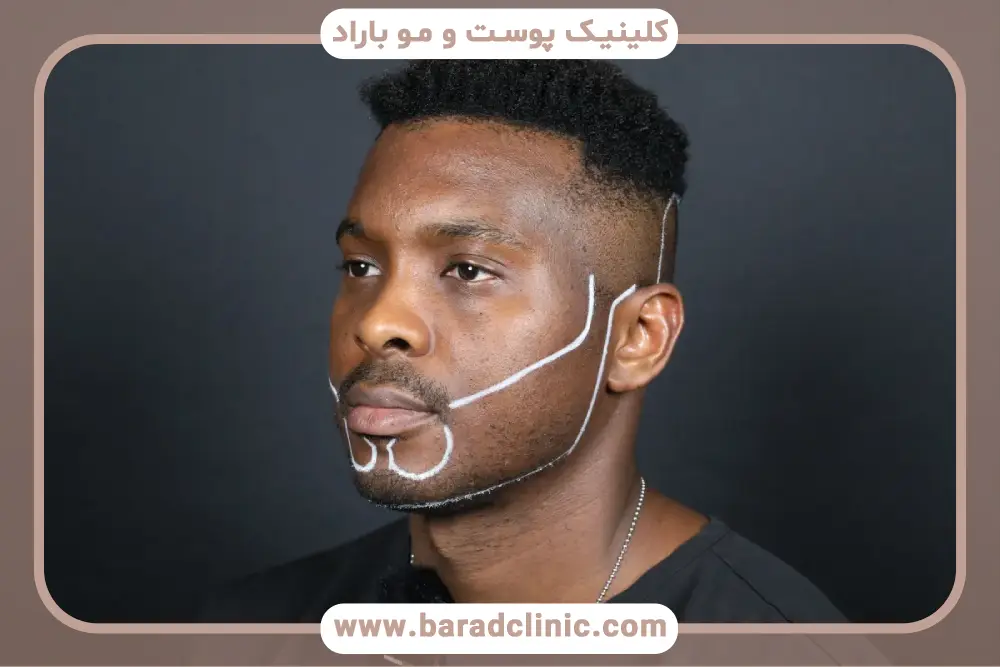 بررسی عوارض کاشت در فیلم کاشت ریش