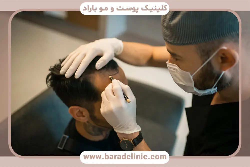 گران‌ترین روش کاشت مو