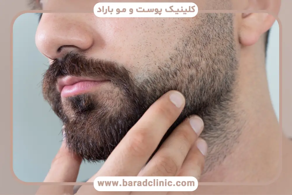 کاندیدای مناسب برای کاشت ریش