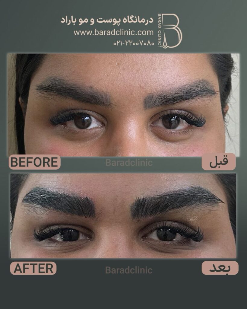 قبل و بعد از کاشت ابرو