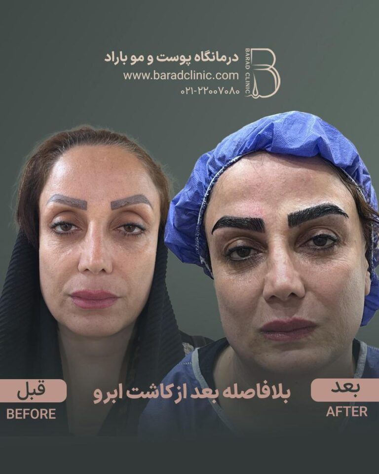 قبل و بعد از کاشت ابرو