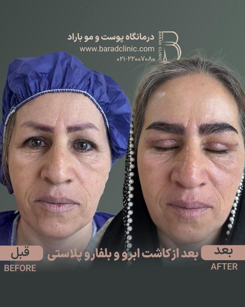 قبل و بعد از کاشت ابرو