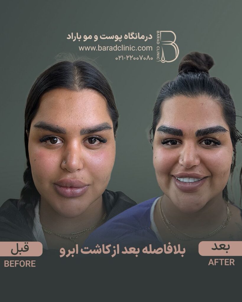 قبل و بعد از کاشت ابرو