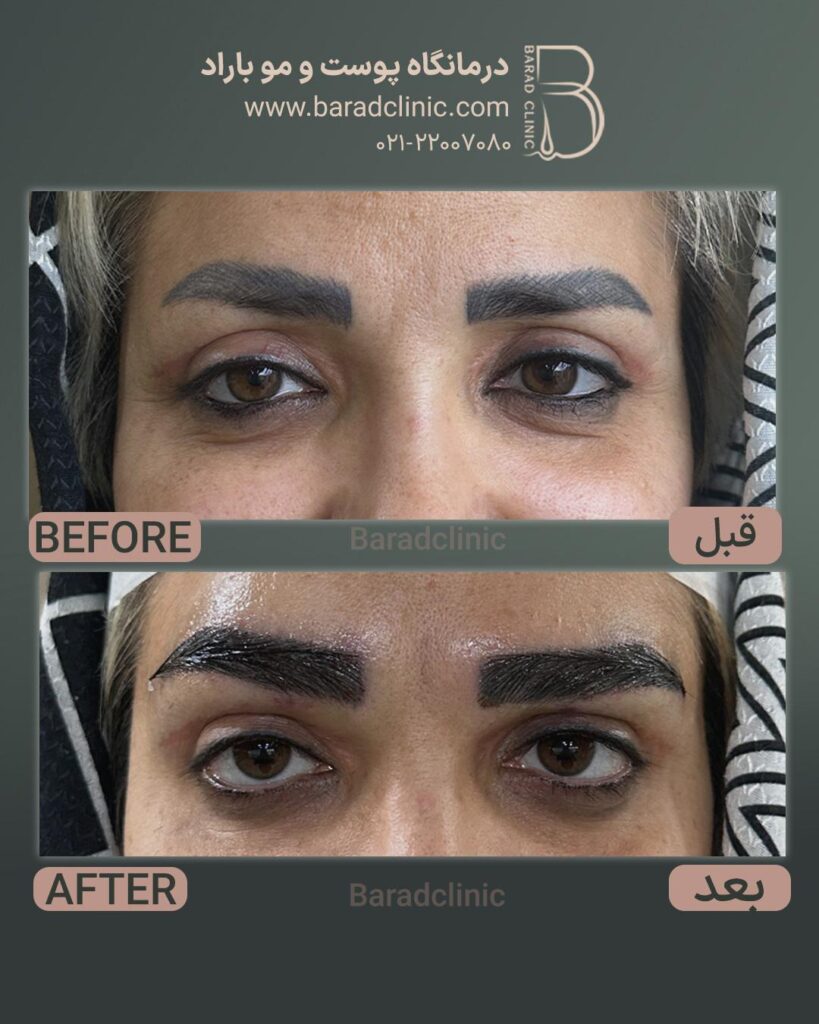 نتیجه کاشت ابرو بعد از سه ماه