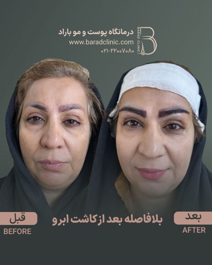 نتیجه کاشت ابرو بعد از سه ماه