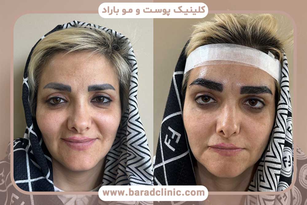 قبل و بعد از کاشت ابرو