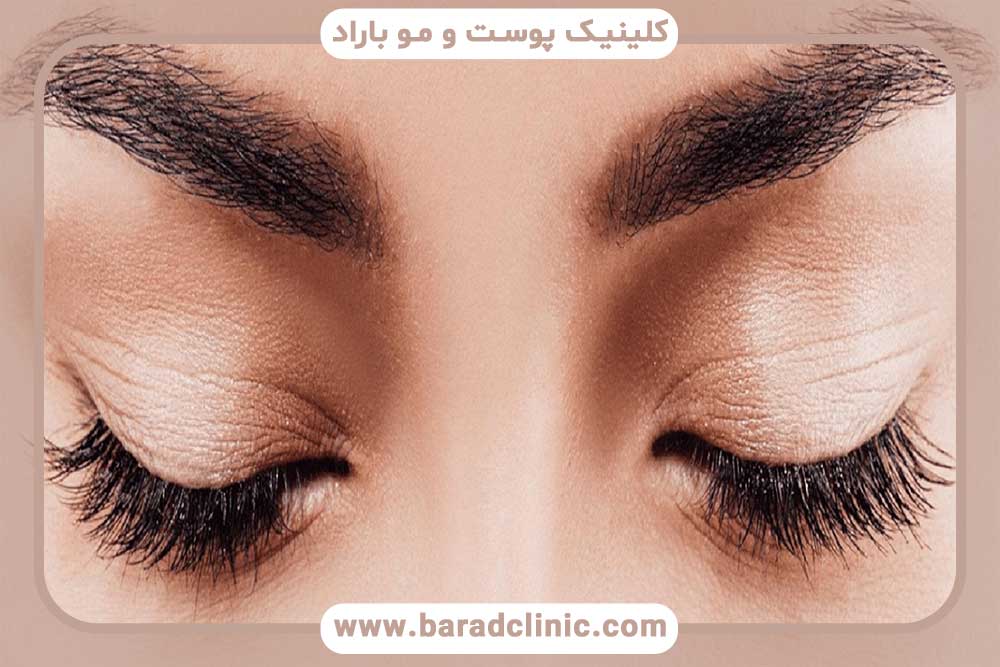 روش کاشت ابرو ترکیبی