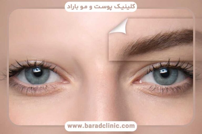 مراحل جلسات کاشت ابرو