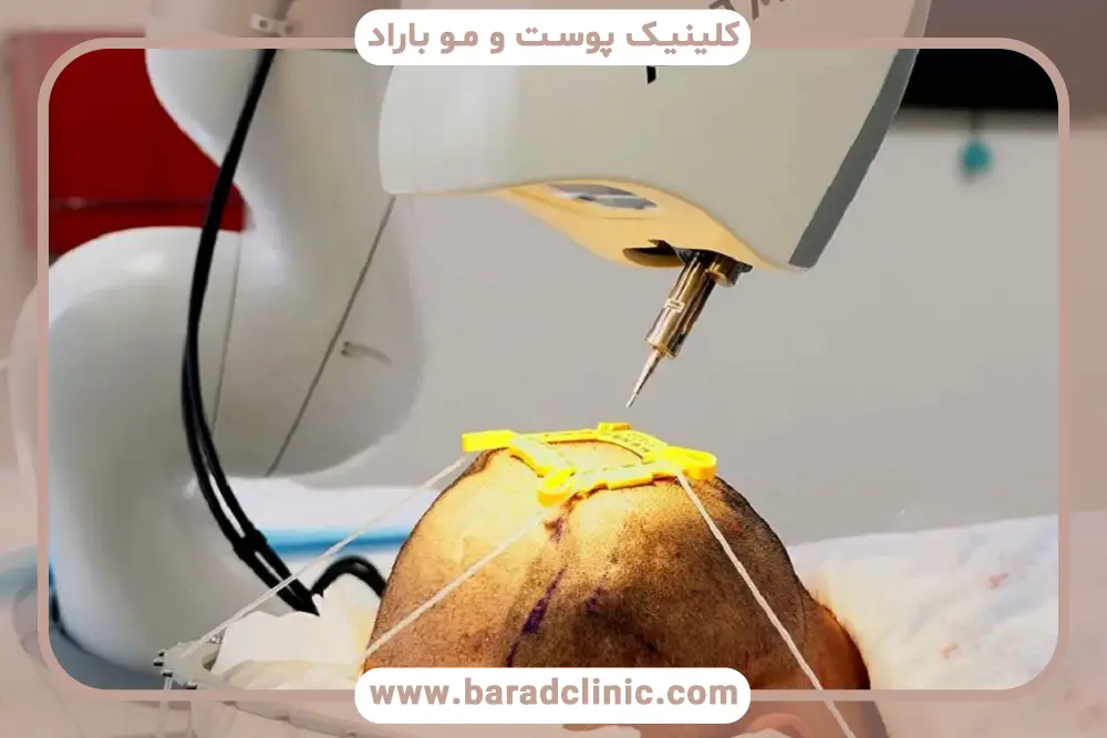 کاشت مو با دستگاه