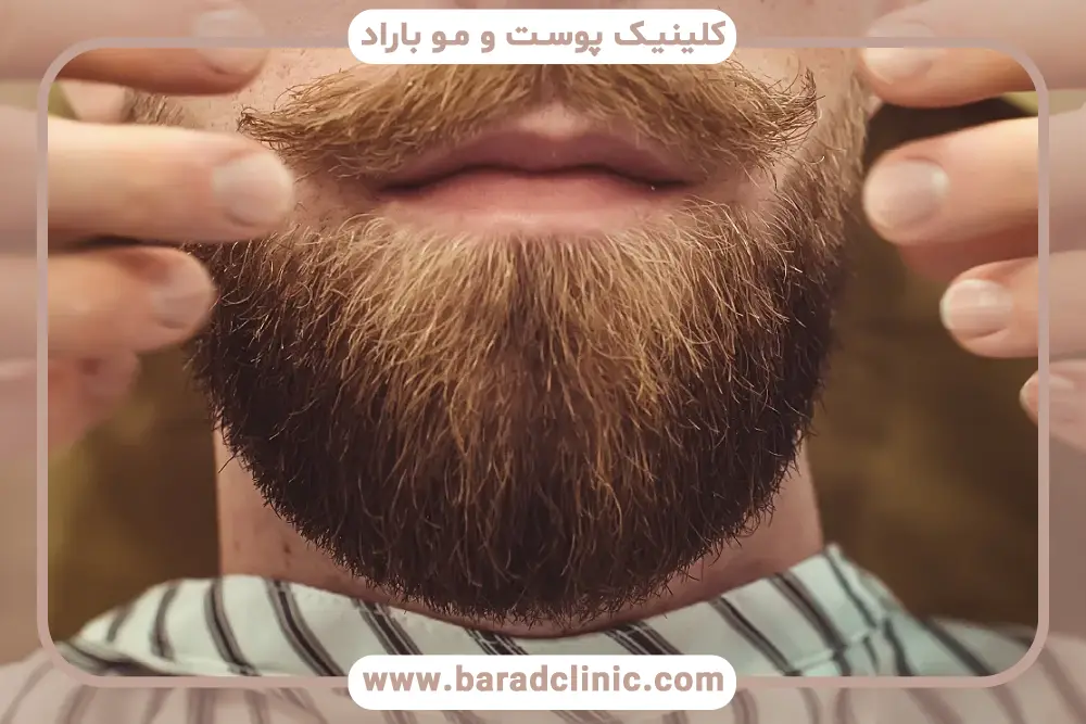 کاشت ریش مردان