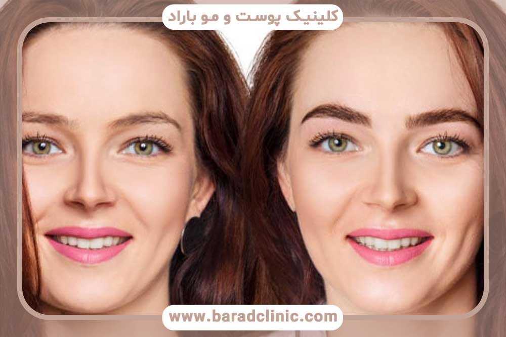 کاشت ابرو برای صورت گرد