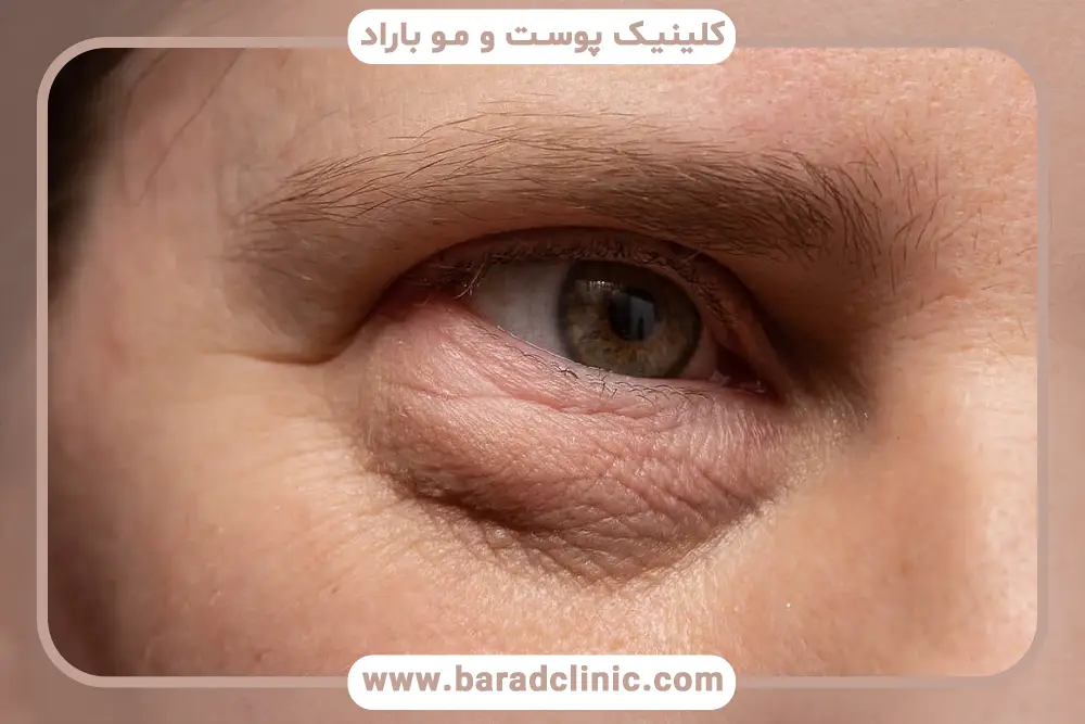 بلفاروپلاستی پف زیر چشم