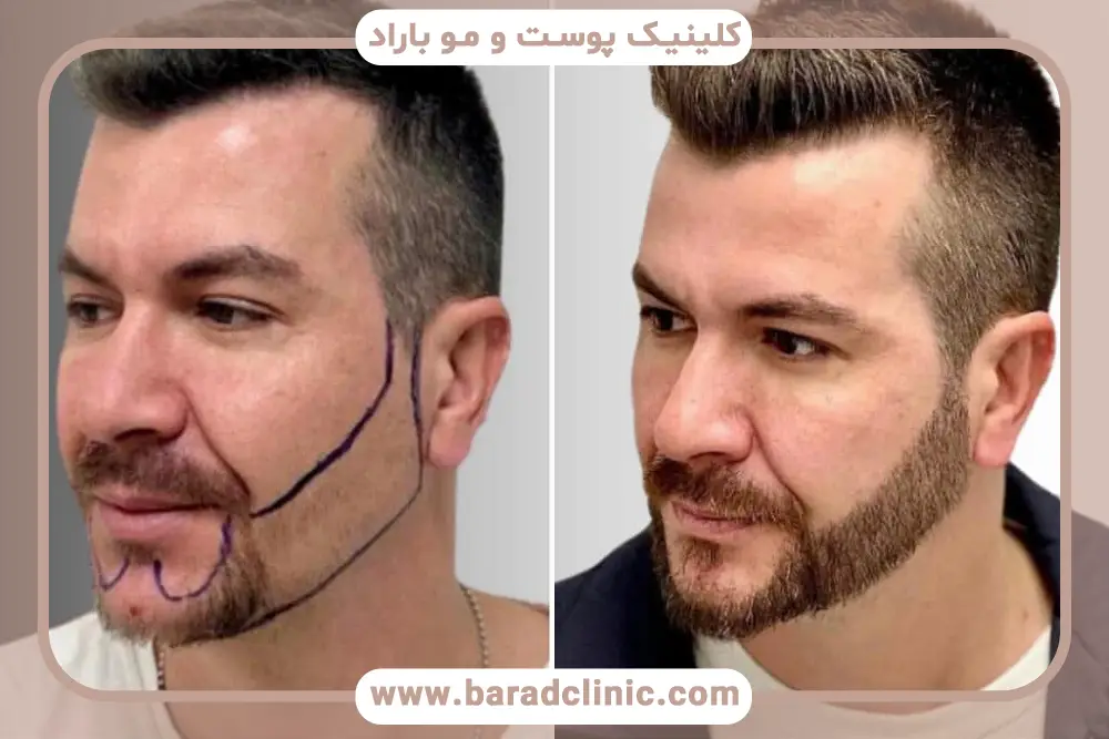 پروسه کاشت ریش