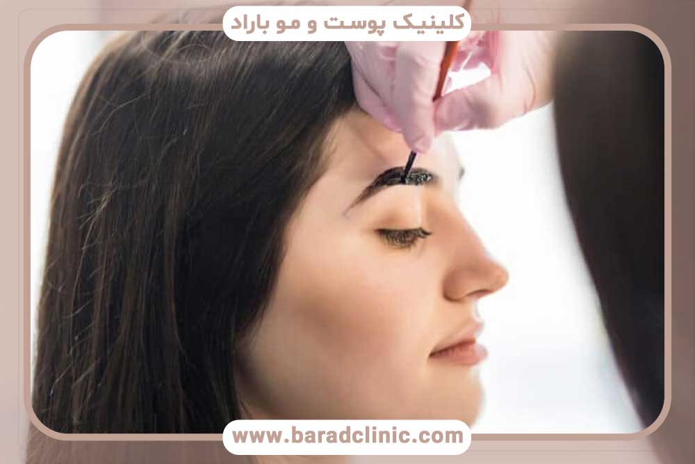 کاشت ابرو لیزری