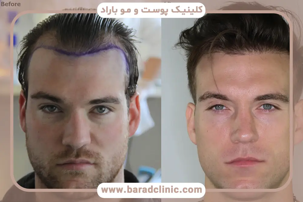 انواع کاشت مو