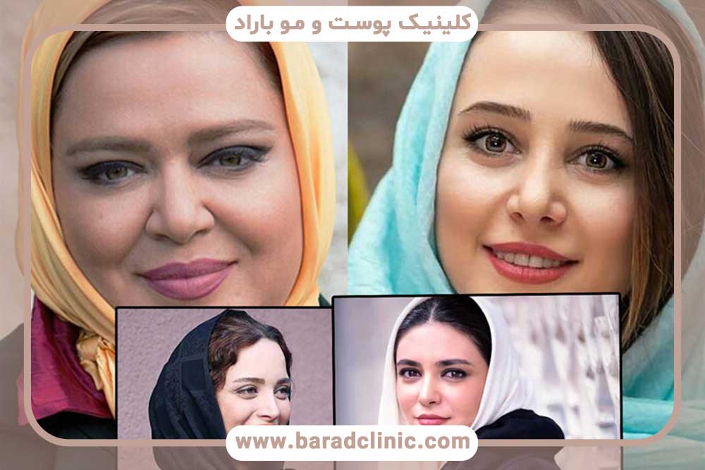 کاشت ابرو بازیگران