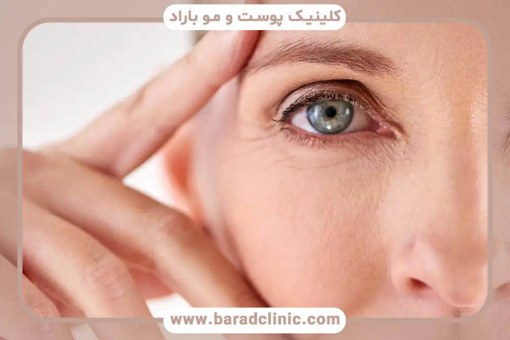 بلفاروپلاستی پلک