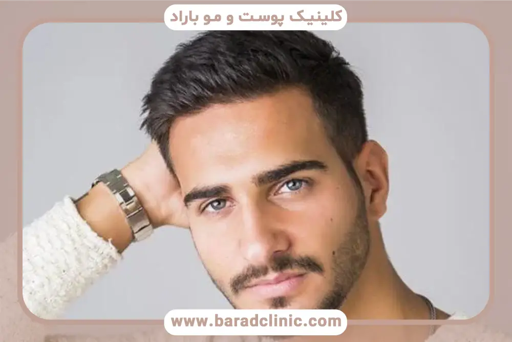 کاشت ریش کم پشت