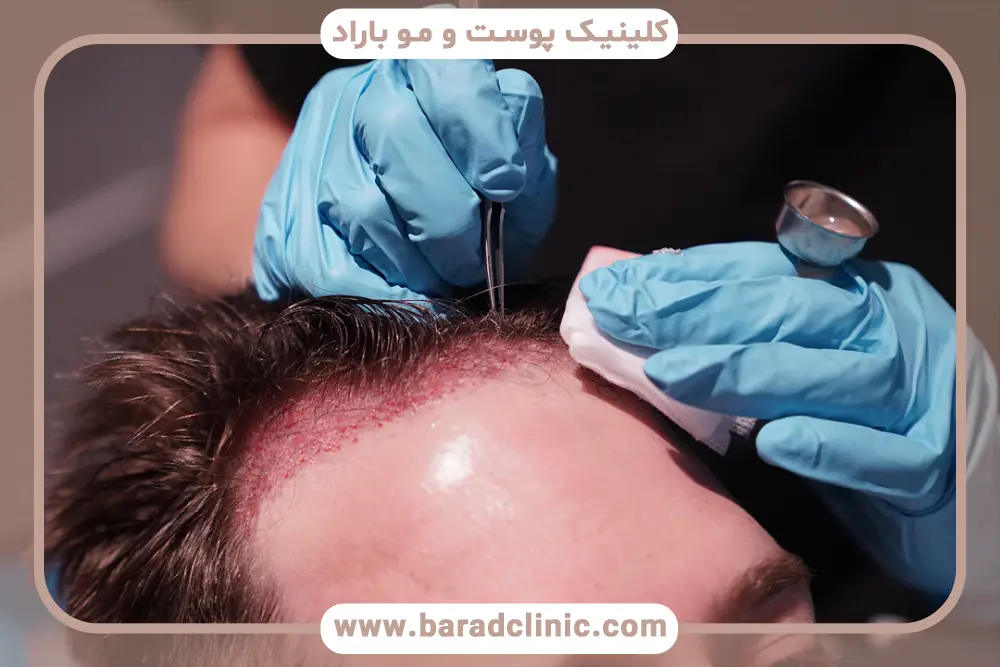 کاشت ریش روی سر