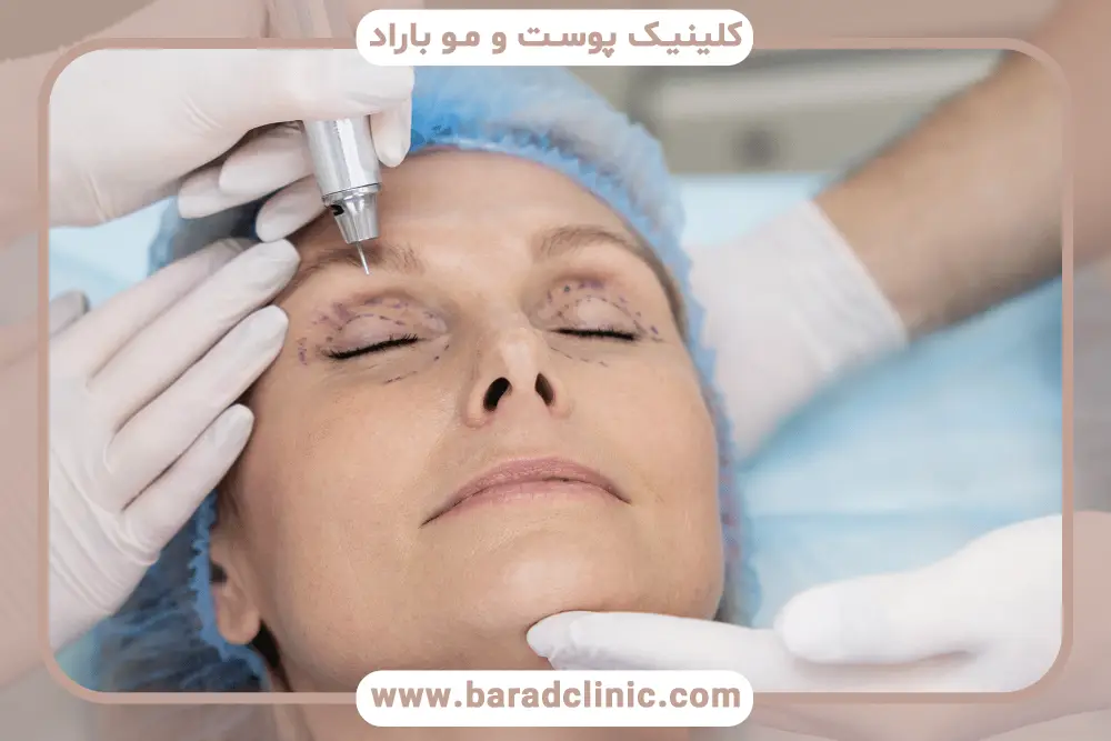 چگونگی عمل بلفاروپلاستی