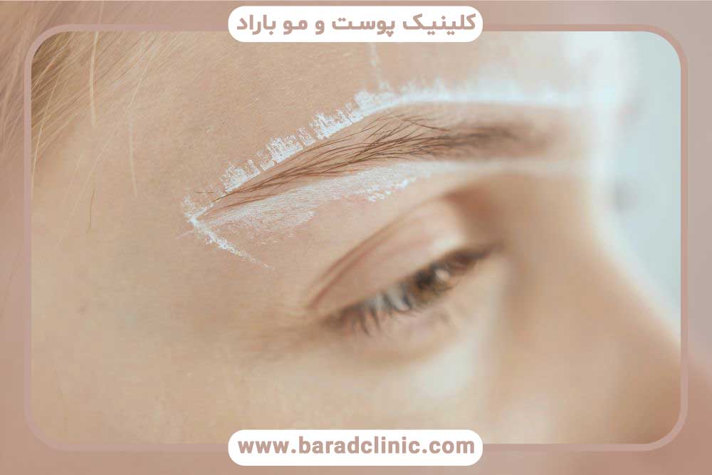 کاشت ابرو و پسوریازیس