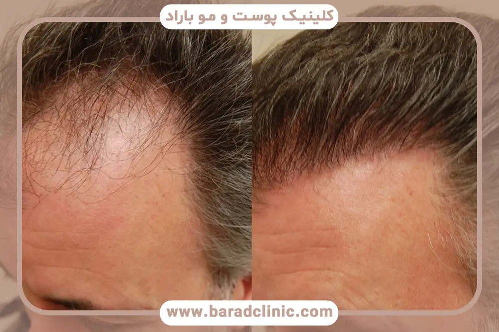 کاشت مو در ایران