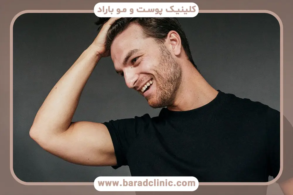 کاشت ریش موقت