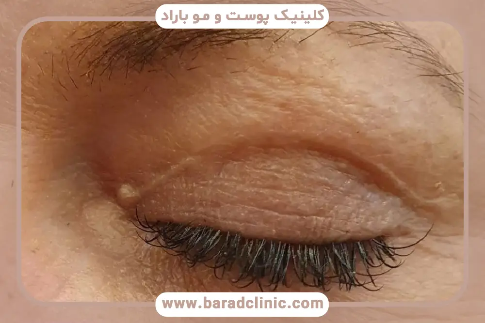 گوشت اضافه بعد از بلفاروپلاستی