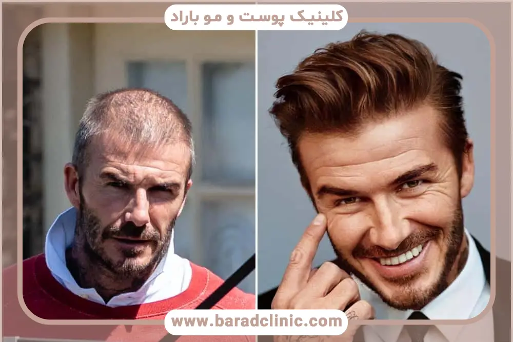 کاشت مو افراد مشهور