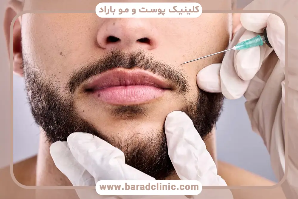 کاشت ریش با نیدل