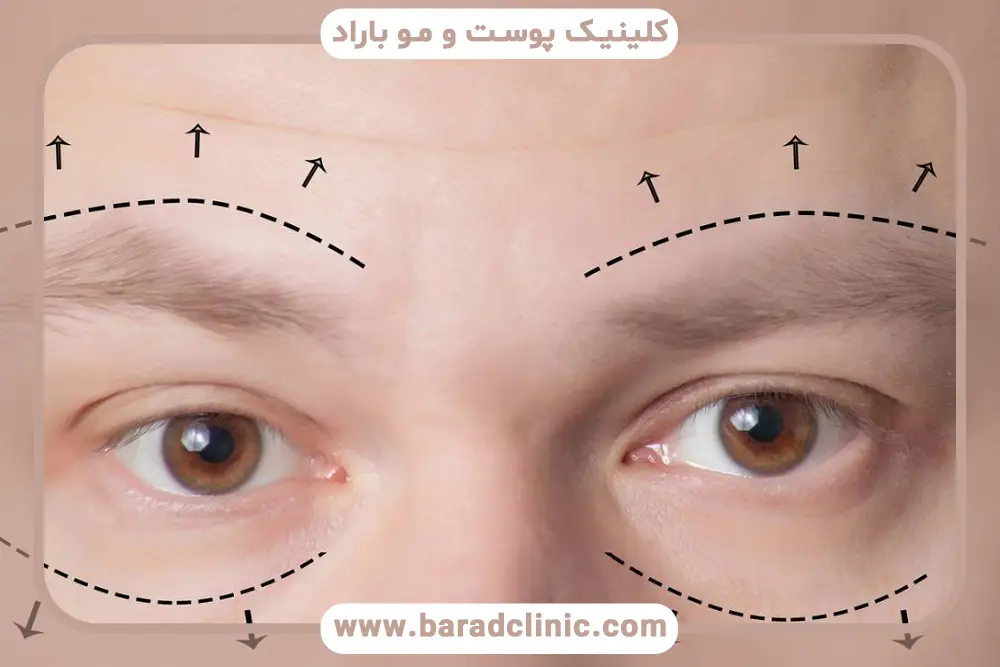 جراحی زیبایی چشم
