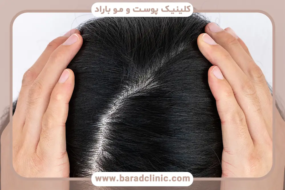 جلوگیری از ریزش مو در تنبلی تخمدان