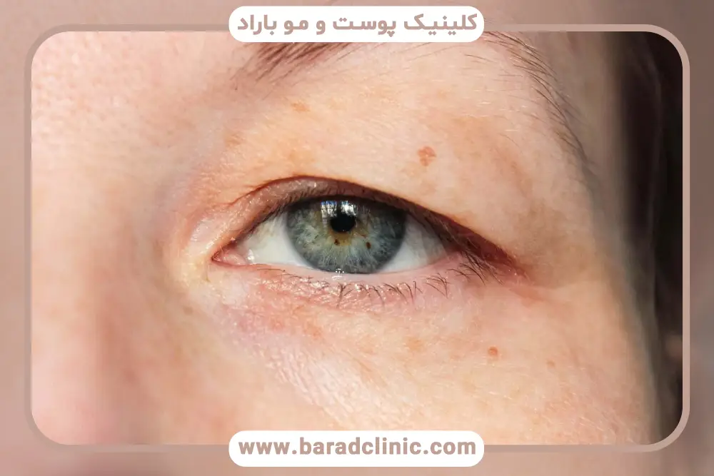 بلفاروپلاستی توسط چشم پزشک