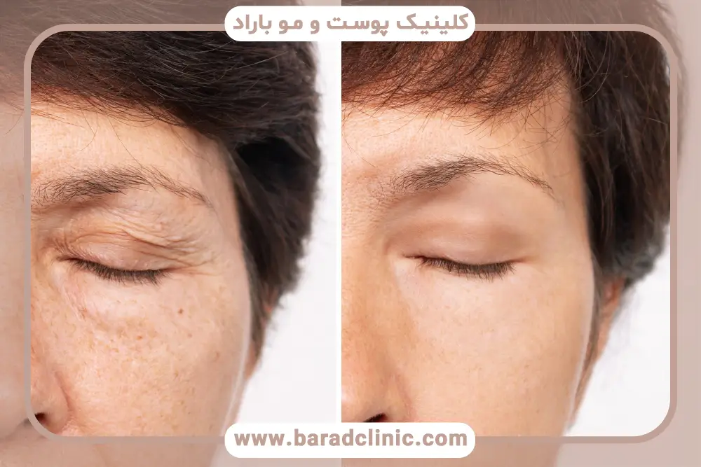 بلفاروپلاستی توسط پزشک عمومی