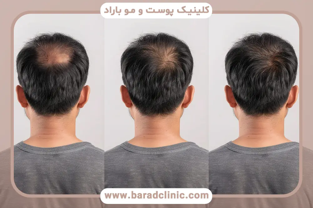 جلوگیری از ریزش مو تستوسترون