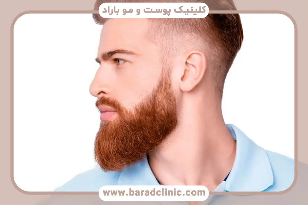 کاشت ریش نظرات