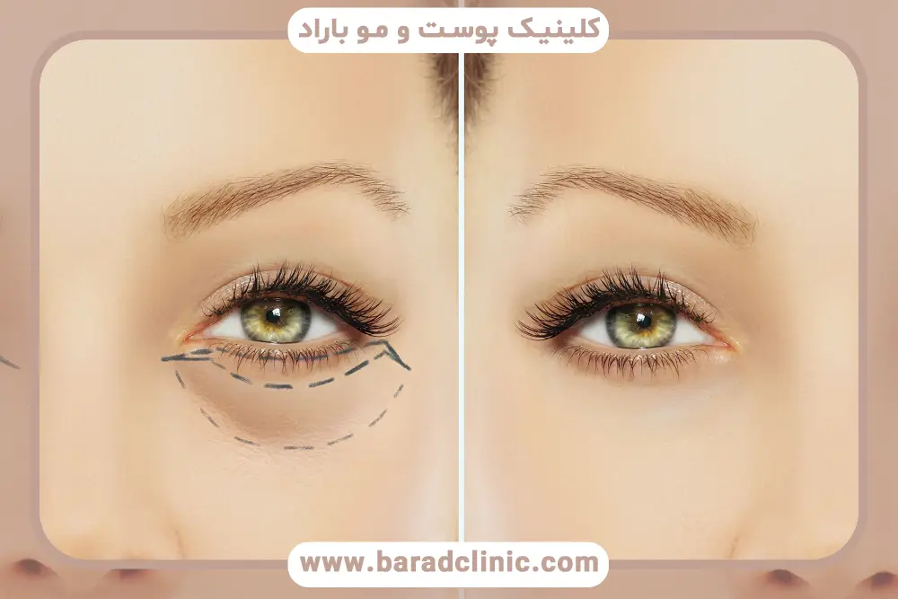 یک ماه بعد از عمل بلفاروپلاستی