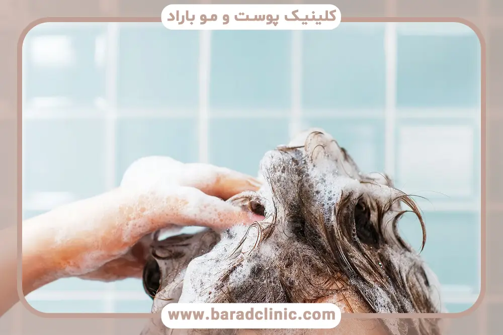 بهترین شامپو بعد از کاشت مو
