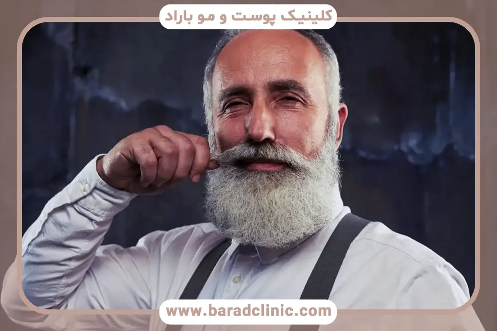 کاشت ریش سفید