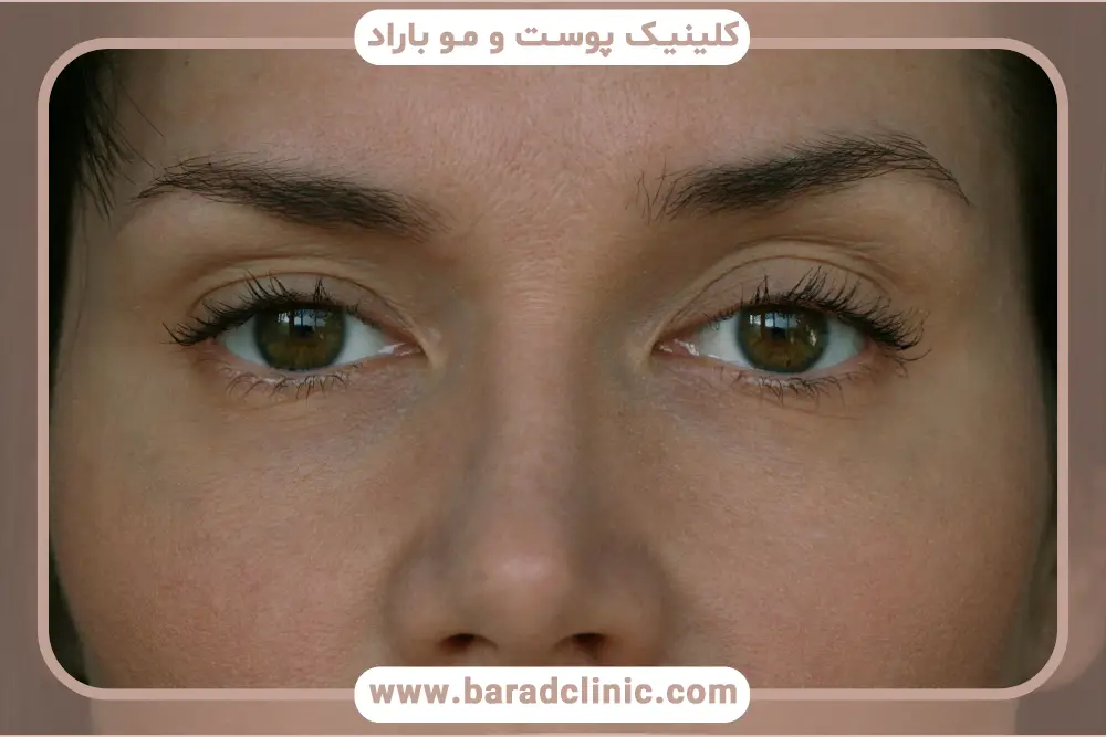 علت افتادگی چشم و روش های درمان آن