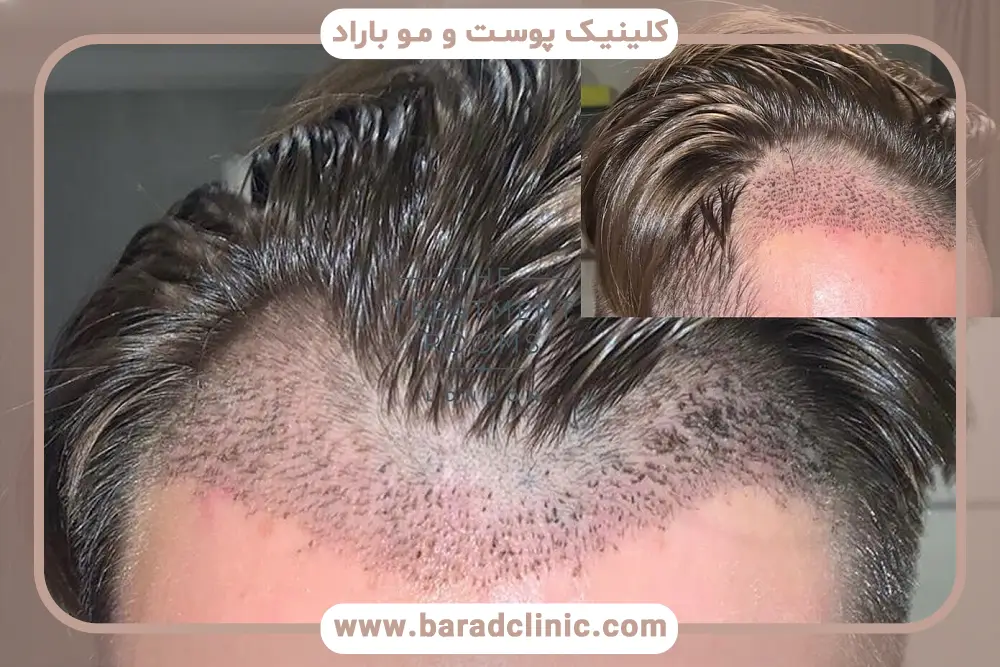 نور آفتاب بعد از کاشت مو