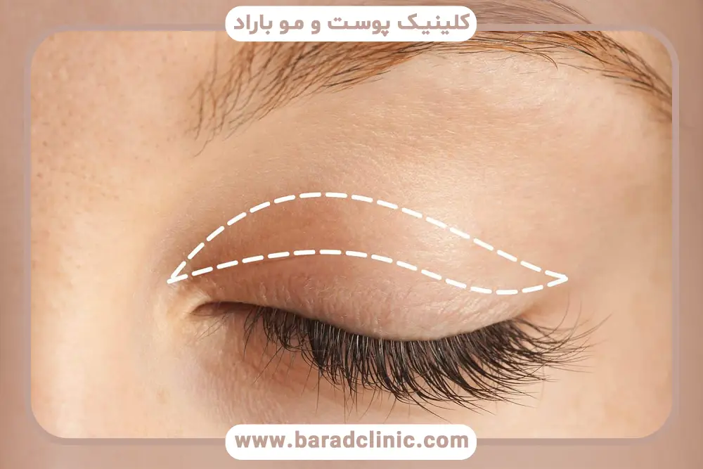 بلفاروپلاستی چهار پلک