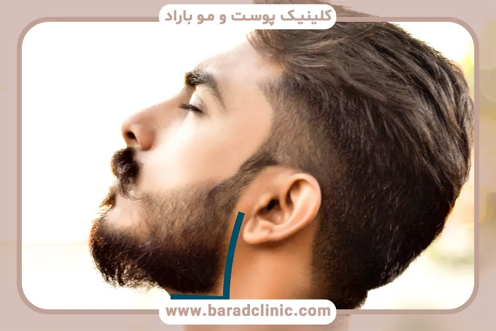 خط کاشت ریش